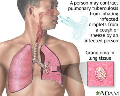 የሳንባ ነቀርሳ በሽታ Tuberculosis-TB